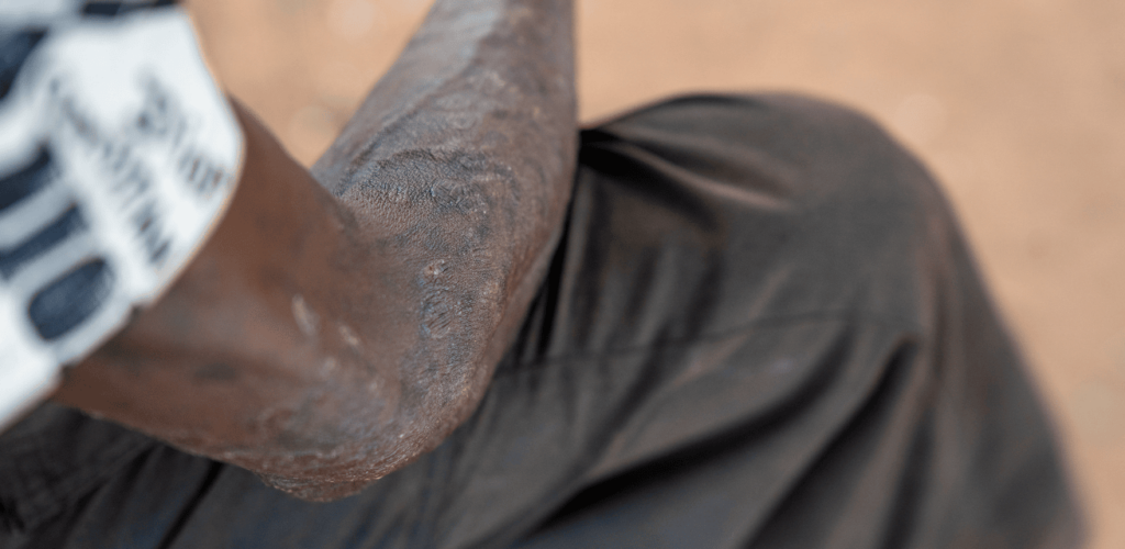 Mpox uitbraak Afrikaanse Continent